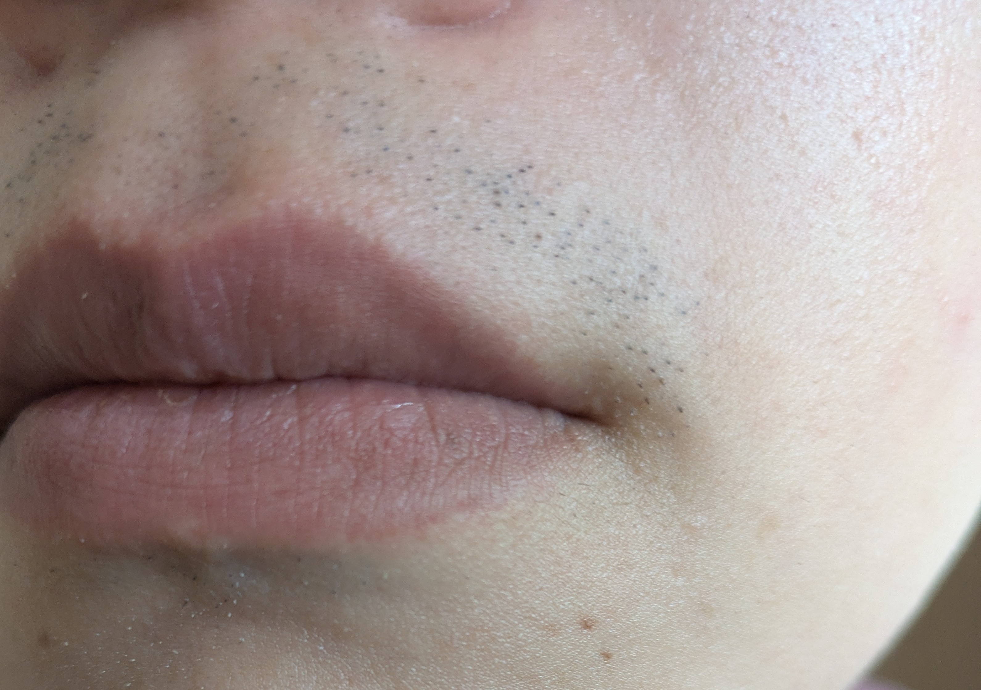 8回目施術から約1週間後、朝・1日剃らずの記録用写真