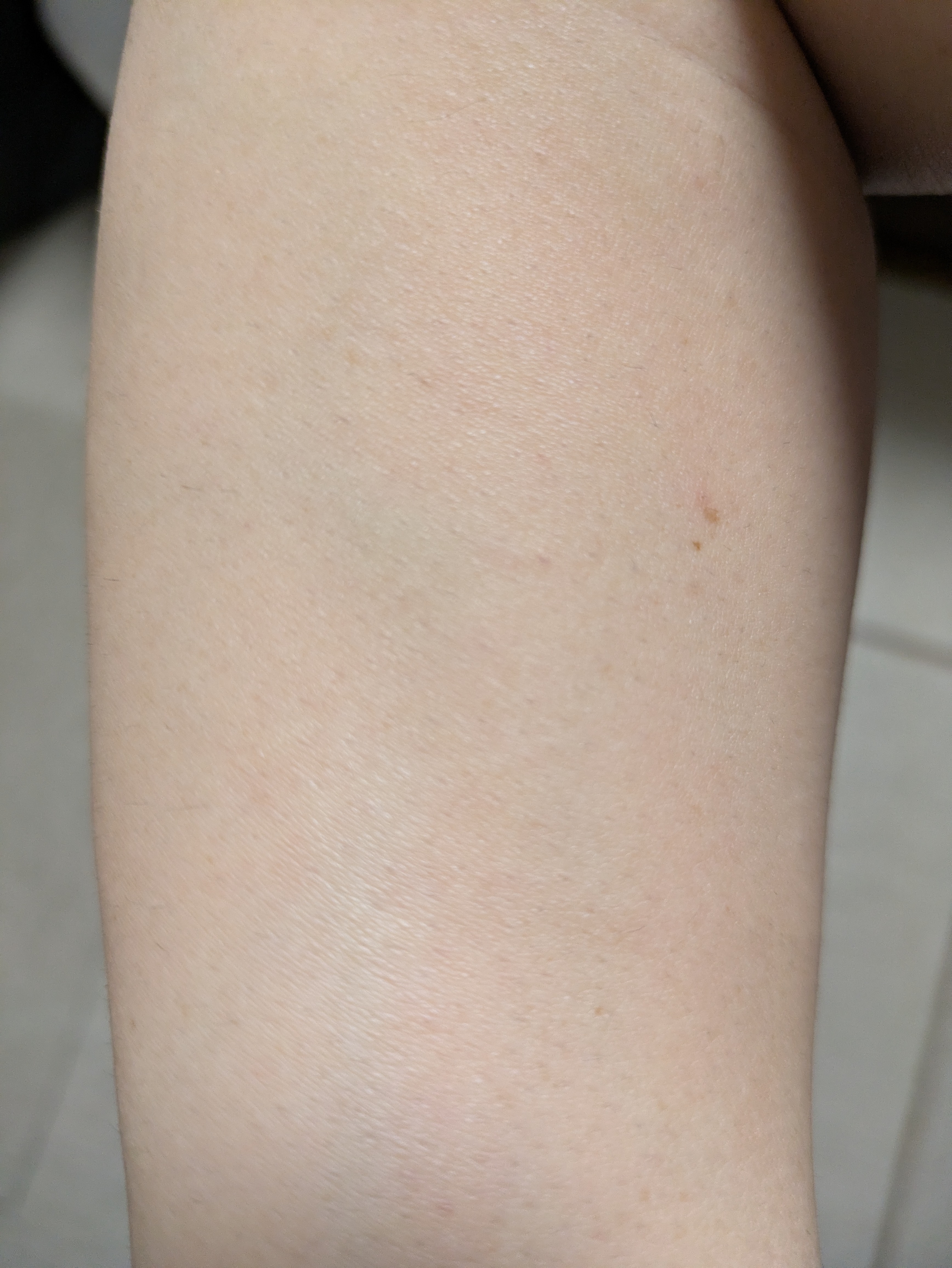 腕まわり（医療脱毛8回施術後、本人の記録）