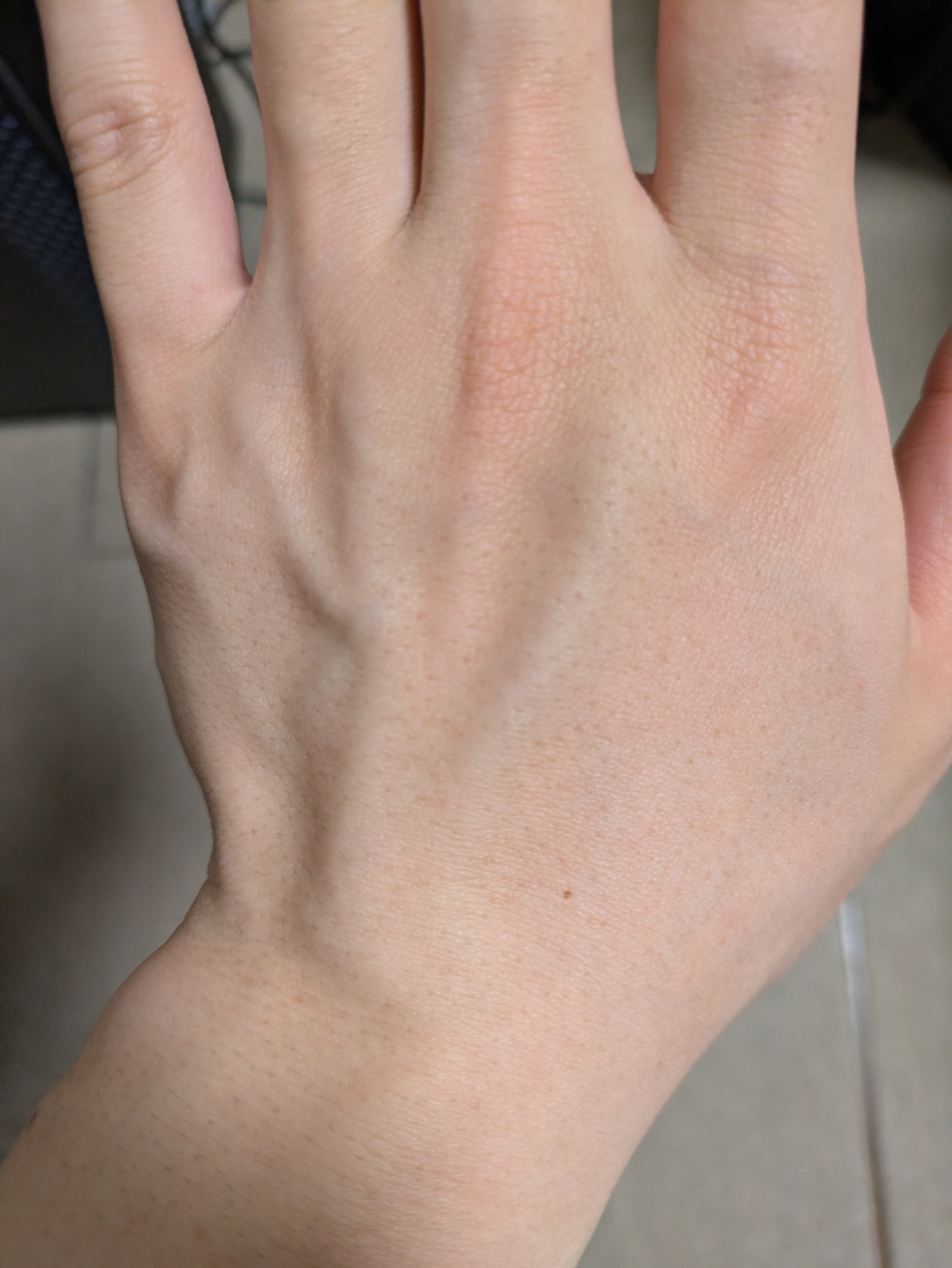 手の甲（医療脱毛8回施術後、本人の記録）