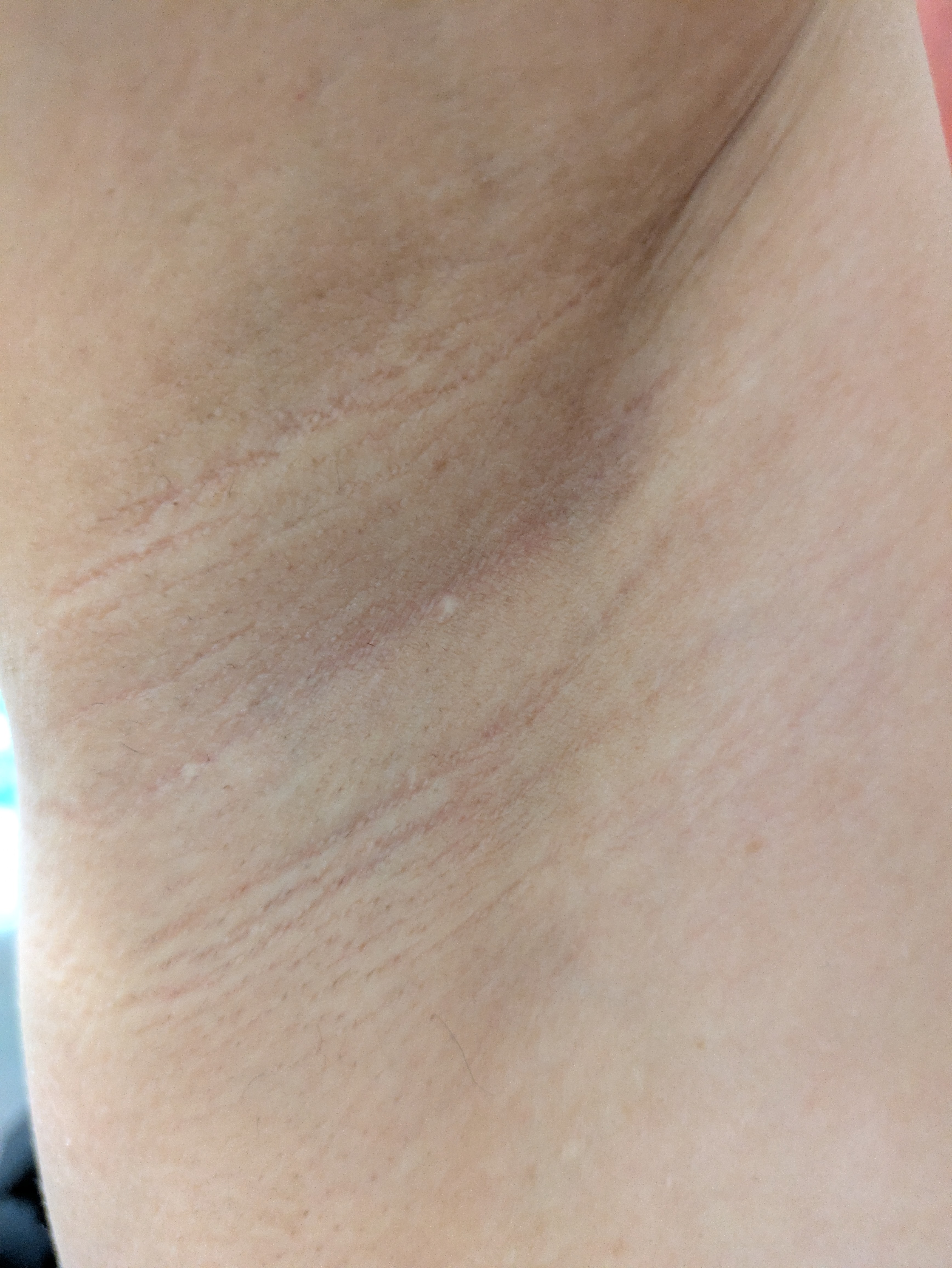 脇（医療脱毛8回施術後、本人の記録）